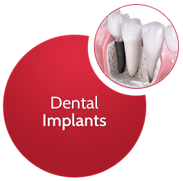Dental Implants