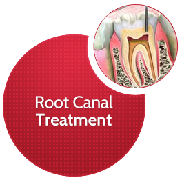 Root Canal Treatment