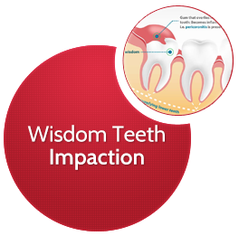 Wisdom Teeth Impaction